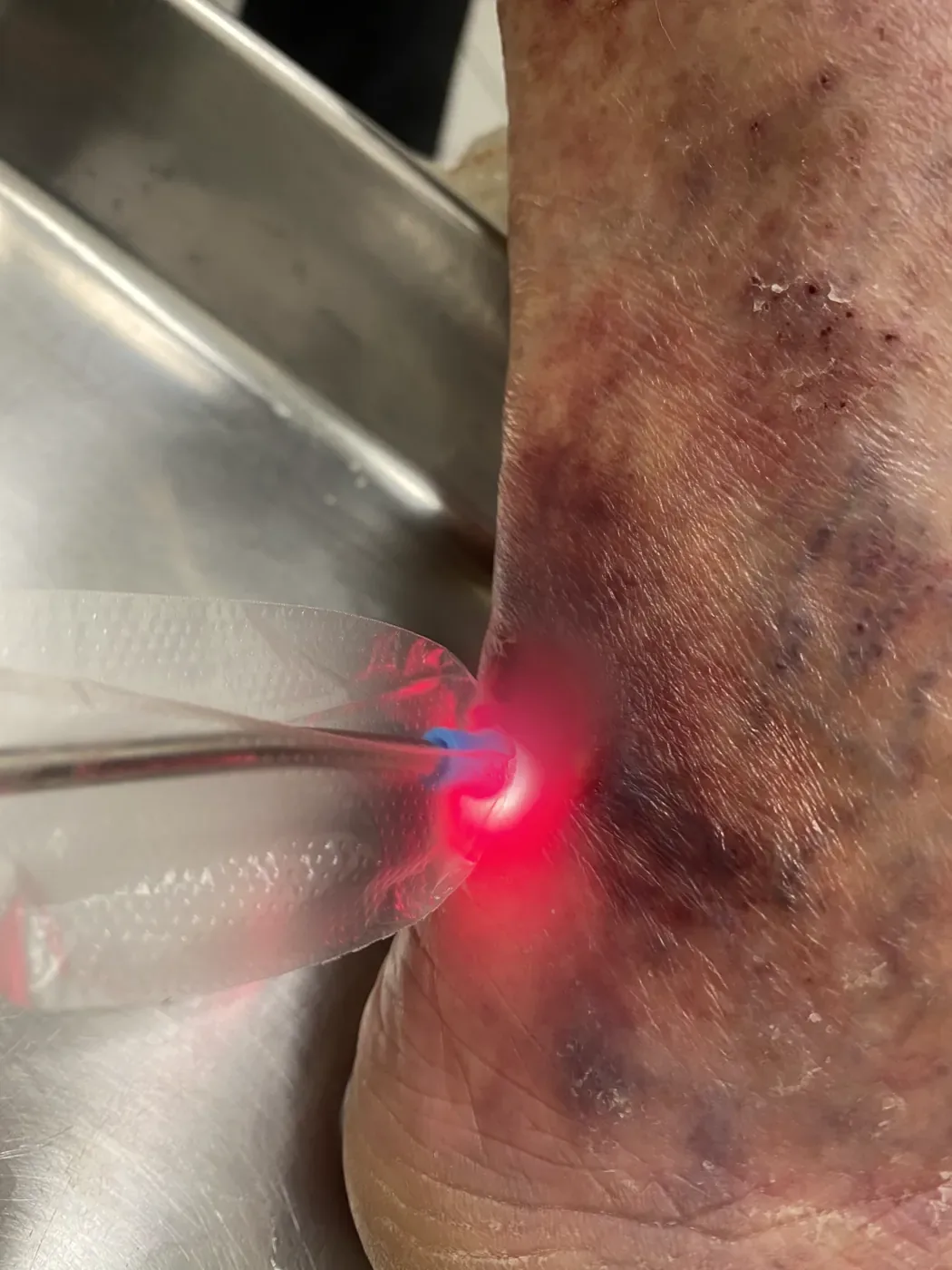 Curativo domiciliar com laserterapia em lesão no retropé, em Porto Alegre, com a lesão desfocada