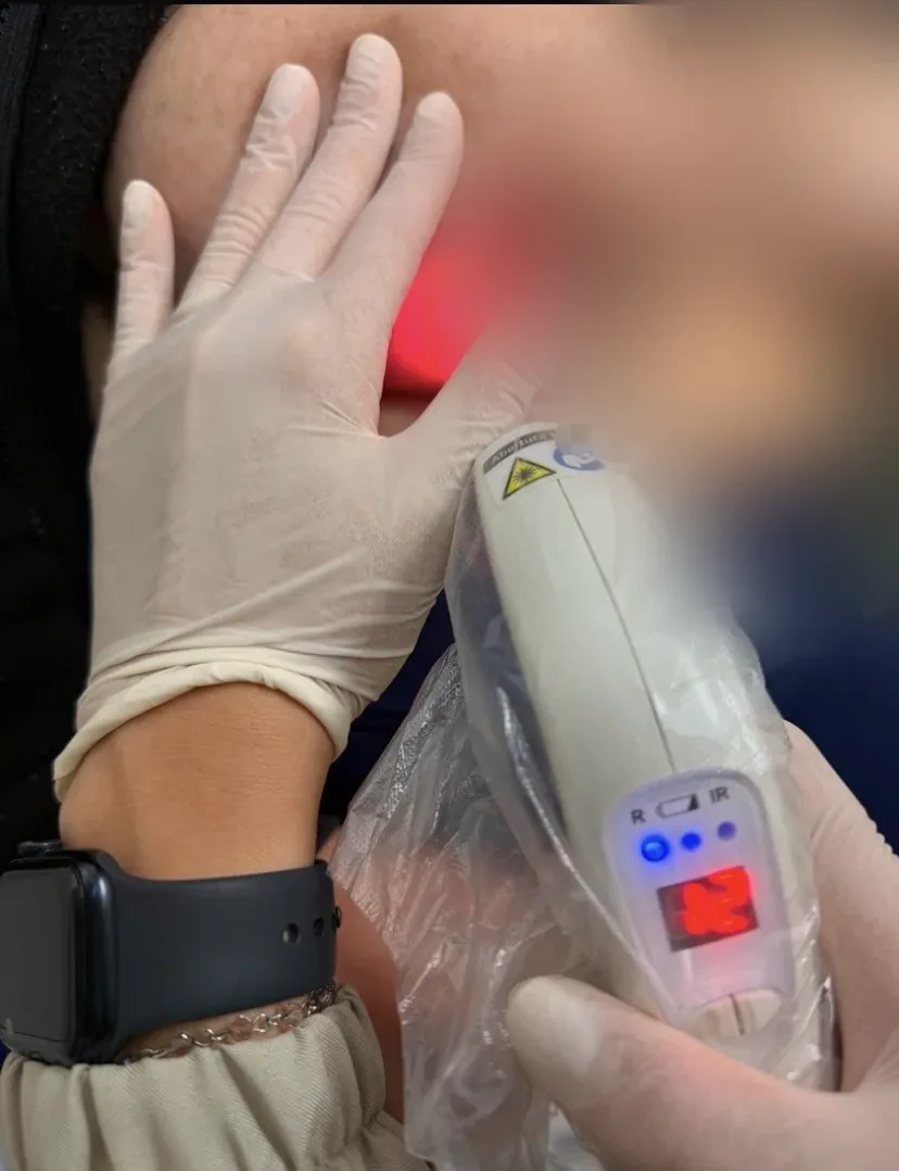 Laser para fissura mamária na amamentação, aplicado em casa em Porto Alegre, com a região da auréola desfocada