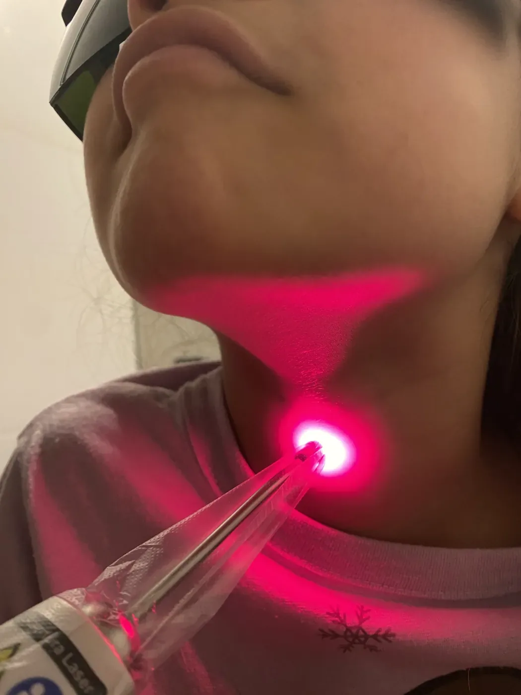 Laserterapia em dermatite infantil em Porto Alegre, com a criança de óculos de proteção