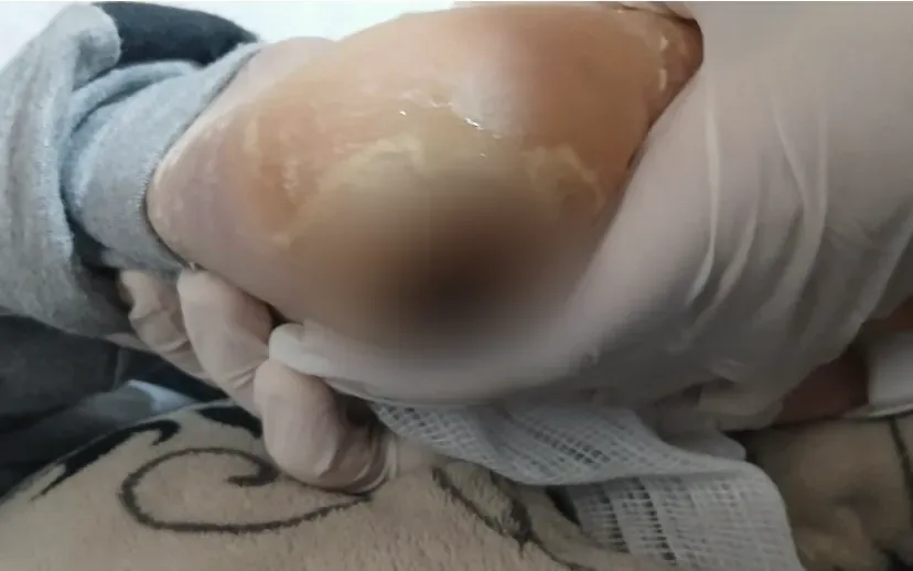 Tratamento de lesão por pressão em calcâneo em casa, em Porto Alegre, com a lesão desfocada