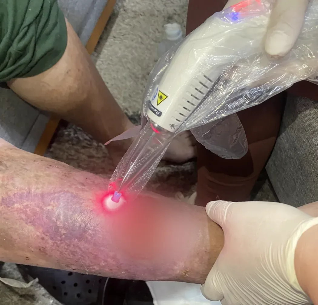 Tratamento de úlcera venosa com laserterapia em casa, em Porto Alegre, com a lesão desfocada